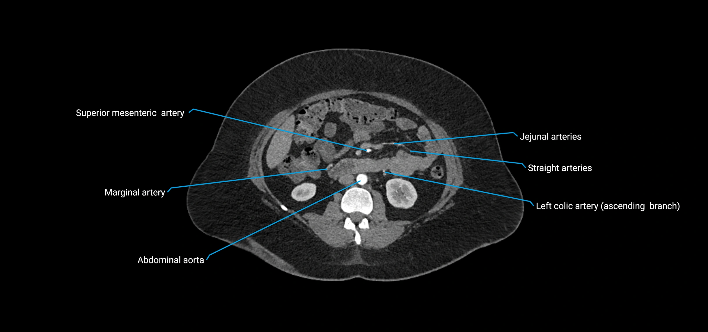 CTA abdomen axial cross sectional anatomy labelled image_91 (2).webp